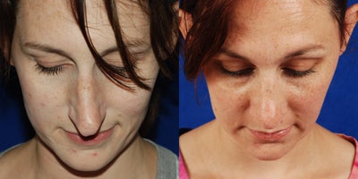 Rhinoplasty before and after photo
