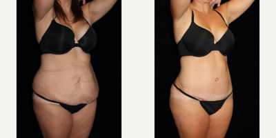 Tummy Tuck before and after photo