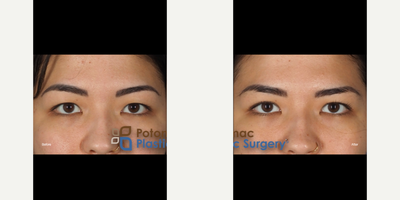 Eyelid Surgery before and after photo