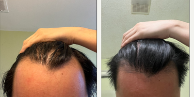 Hair Loss Treatment before and after photo