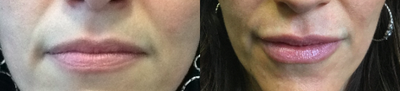 Lip Fillers before and after photo