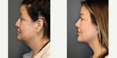 before and after image