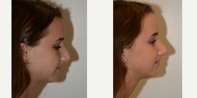 Rhinoplasty before and after photo