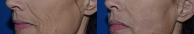 Belotero before and after photo