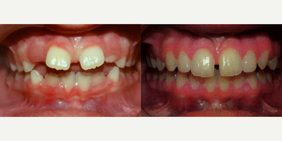 Braces before and after photo