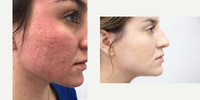 CO2 Laser before and after photo