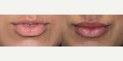 Dermal Fillers before and after photo