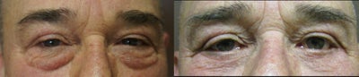 Eyelid Surgery before and after photo