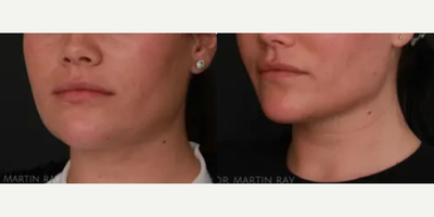 Morpheus8 before and after photo