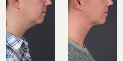 Neck Lift before and after photo