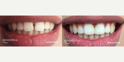 Porcelain Veneers before and after photo