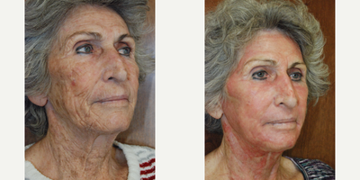 Renuvion for Facial Resurfacing before and after photo