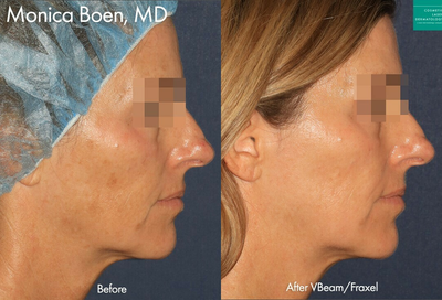 Vbeam before and after photo