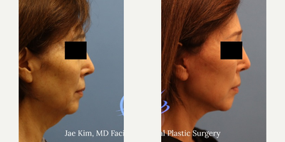 Facelift before and after photo