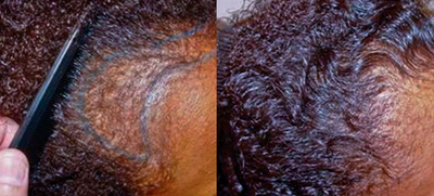 Hair Transplant before and after photo