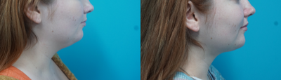 Liposuction before and after photo