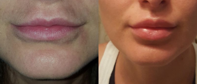 Restylane Refyne before and after photo