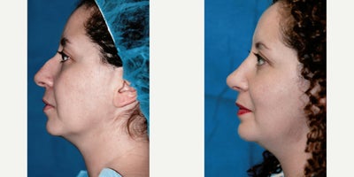 Rhinoplasty before and after photo