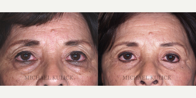 Eyelid Surgery before and after photo