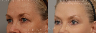 Eyelid Surgery before and after photo