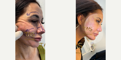 Facelift before and after photo