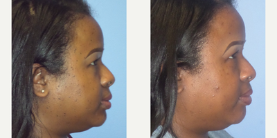 CO2 Laser before and after photo
