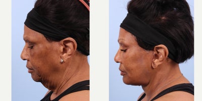 Neck Lift before and after photo