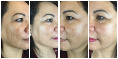 PicoSure before and after photo