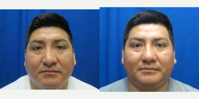 Rhinoplasty before and after photo