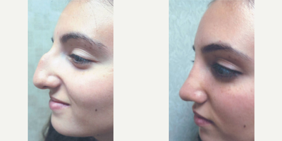 Rhinoplasty before and after photo