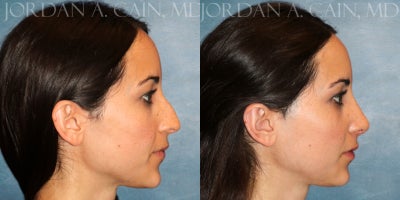 Rhinoplasty before and after photo