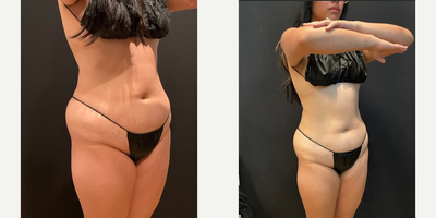 Semaglutide before and after photo