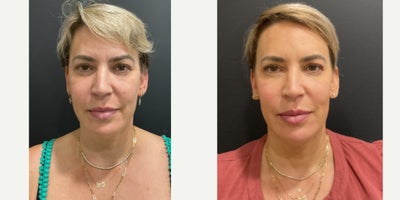 Sofwave before and after photo