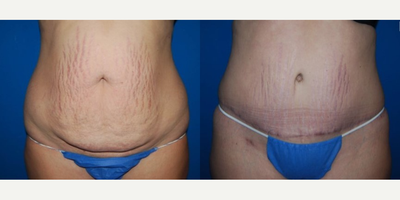 Tummy Tuck before and after photo