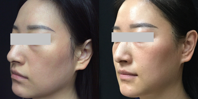 Ultherapy before and after photo