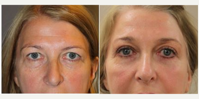 Brow Lift before and after photo