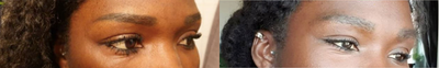 Eyebrow Transplant before and after photo