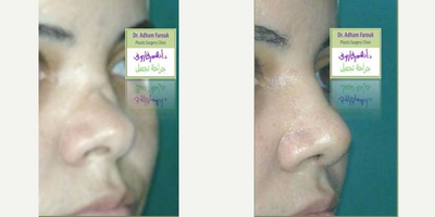 Rhinoplasty before and after photo