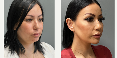 Brow Lift before and after photo