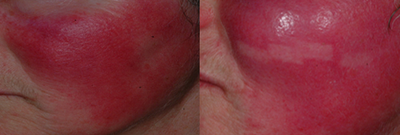 Laser Resurfacing before and after photo