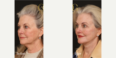 Lip Lift before and after photo