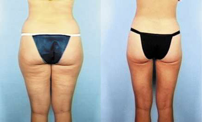 Liposuction before and after photo