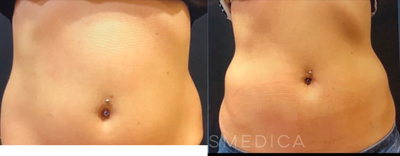 SculpSure before and after photo