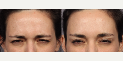 Botox before and after photo