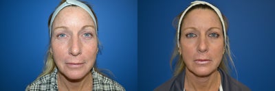 Fractional Laser before and after photo