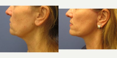 Lower Facelift before and after photo
