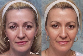 Botox before and after photo