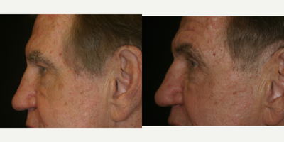 Eyelid Surgery before and after photo
