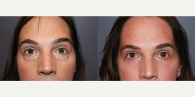 Eyelid Surgery before and after photo