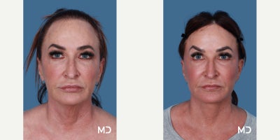 Facelift before and after photo